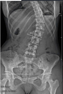 Radiographie de scoliose avec mesure de l'angle de Cobb